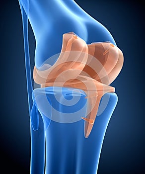 Knee and titanium hinge joint. X-ray view
