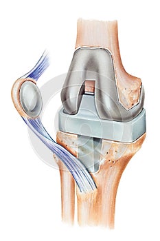 Knee -Total Replacement