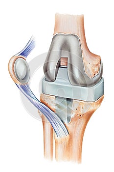 Knee -Total Replacement photo