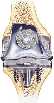 Knee - Total Replacement - Showing Cutaway View of Implant