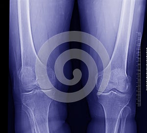 Knee x-ray