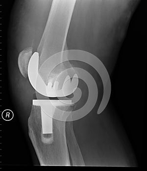 Knee X Ray photo