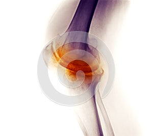 Knee X-ray, severe degenerative osteoarthritis photo