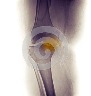 Knee X-ray, severe degenerative osteoarthritis photo