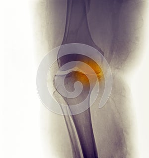 Knee X-ray, severe degenerative osteoarthritis