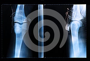 Knee X-ray after arthroscopic surgery photo