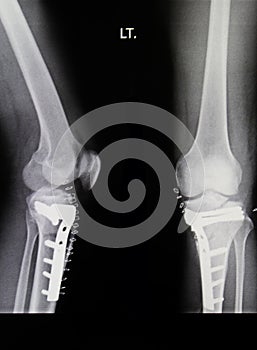 Knee x-rays image