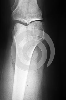 Knee Xray photo