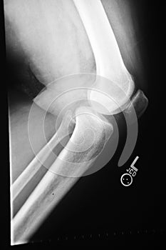 Knee Xray