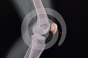 Knee xray of a patient showing a lucent line at lower part of patella photo