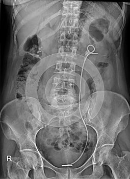 KUB x-ray showing double j stent left kidney to bladder