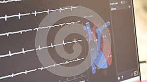 Kyiv, Ukraine - April 2023: Heart Institute. The patient monitor shows heart data