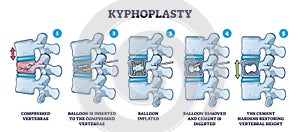 Kyphoplasty invasive surgery for spinal compression fracture outline diagram