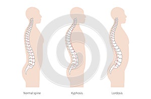 Kyphosis, lordosis flat vector illustration.