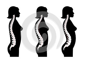 Kyphosis, lordosis flat vector illustration.