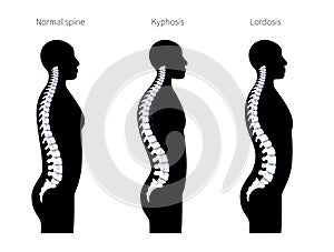 Kyphosis, lordosis flat vector illustration.