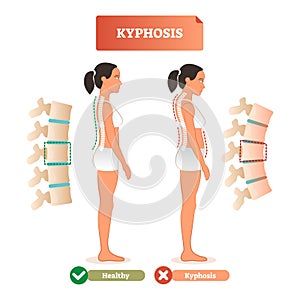 Kyphosis vector illustration. Back spine defect diagnosis vs healthy. photo