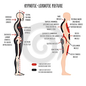 Kyphotic lordotic posture. The side view shows deformation of rounded shoulders and hyperlordosis, pelvis rotation, stretched and