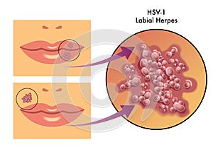 Labial herpes