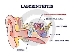 Labyrinthitis as inner ear infection and medical inflammation outline diagram