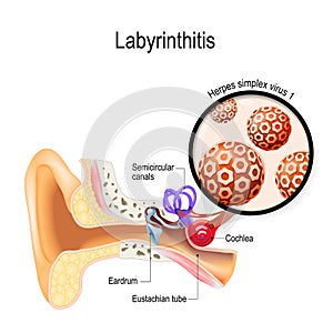 Labyrinthitis. inflammation of the inner ear and Herpes simplex virus that caused this disease photo