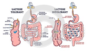 Lactose intolerance and tolerance medical process differences outline diagram