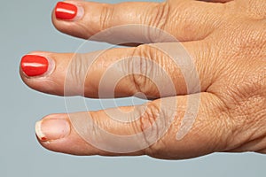 Lady's hand with ruined nail polish on the nails. Semi-permanent nail polish to be redone