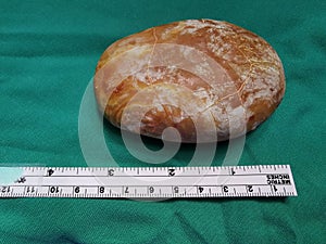 Laminated Urinary Bladder Stone extracted via Open Vesicolithotomy