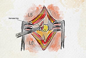 Laminectomy Surgical Procedure showing herniated disc at L5 and L6