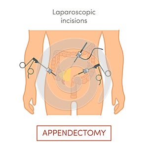 Laparoscopic appendectomy - appendix removal