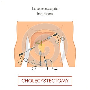 Laparoscopic cholecystectomy - gallbladder removal photo