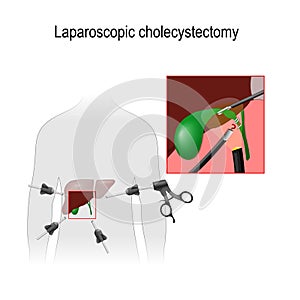 Laparoscopic Cholecystectomy photo