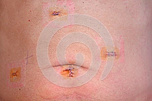 Laparoscopic Cholocystectomy Scars photo