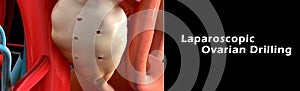 Laparoscopic Ovarian Drilling photo