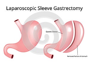 Laparoscopic Sleeve Gastrectomy / Weight loss surgery - Vector photo