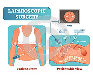 Laparoscopic surgery medical health care surgical procedure process, anatomical cross section vector illustration diagram. photo