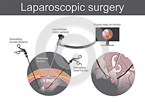 Laparoscopic surgery. Technical surgery which operations are per photo