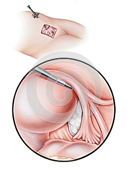 Laparoscopy - Diagnostic