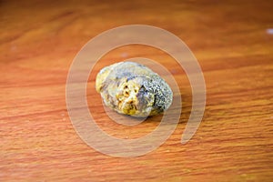 Large gallstone, Gall bladder stone. The result of gallstones