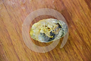 Large gallstone, Gall bladder stone. The result of gallstones