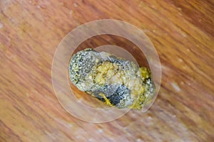 Large gallstone, Gall bladder stone. The result of gallstones