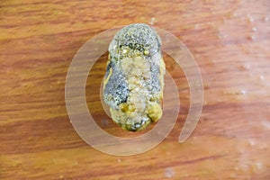 Large gallstone, Gall bladder stone. The result of gallstones