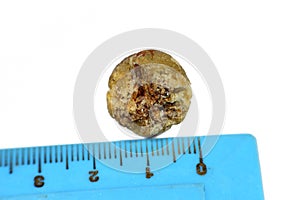 Large gallstone removed surgically after laparoscopic cholecystectomy, Gallstones are hardened deposits of digestive fluid that photo