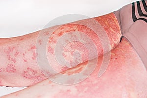 Large inflamed,scaly rash on man's legs.Acute psoriasis, severe reddening of the skin,an autoimmune,incurable