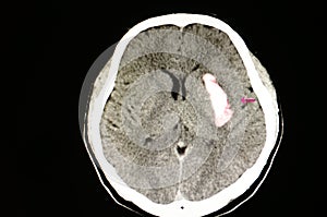 large intracerebral hematoma photo
