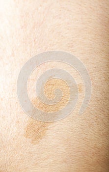 A large light brown cafe au lait spot known as birth mark on the inter scapular region of a caucasian male photo