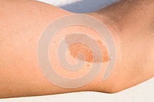 A large mole, birthmark on the skin of the arm of a young man