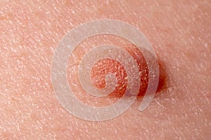 Large mole close-up. Macro shot of benign skin lesion on caucasian, human skin. Proliferation of pigment derma cells. photo