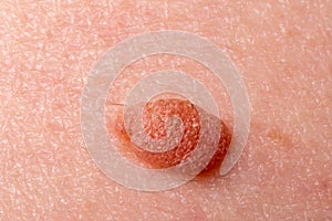 Large mole close-up. Macro shot of benign skin lesion on caucasian, human skin. Proliferation of pigment derma cells, Melanocytic photo