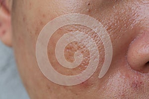 Large pore and blemish asian skin photo